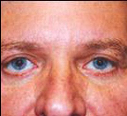 Male Facial Rejuvenation Before & After