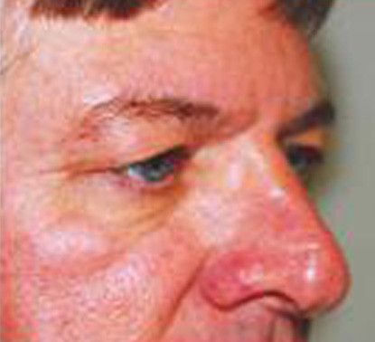 Male Facial Rejuvenation Before & After