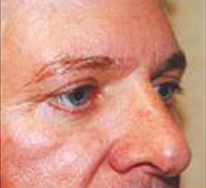 Male Facial Rejuvenation Before & After