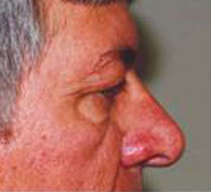 Male Facial Rejuvenation Before & After