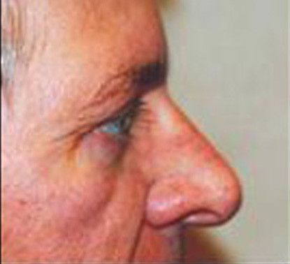 Male Facial Rejuvenation Before & After