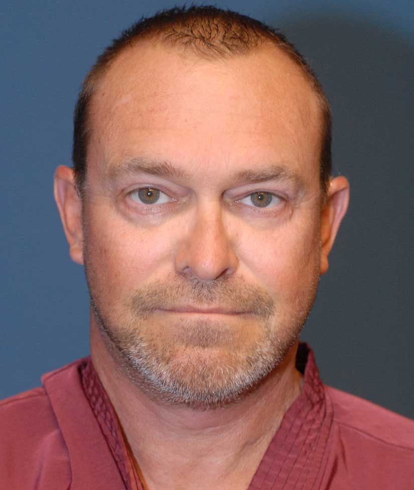 Male Facial Rejuvenation Before & After