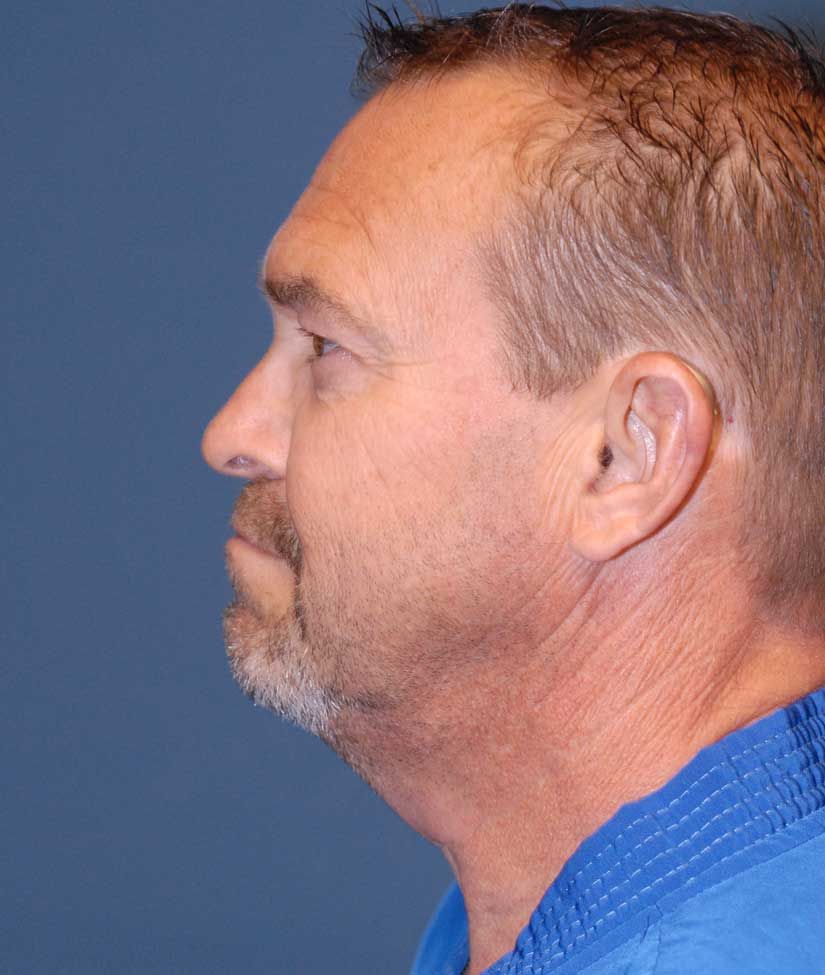 Male Facial Rejuvenation Before & After