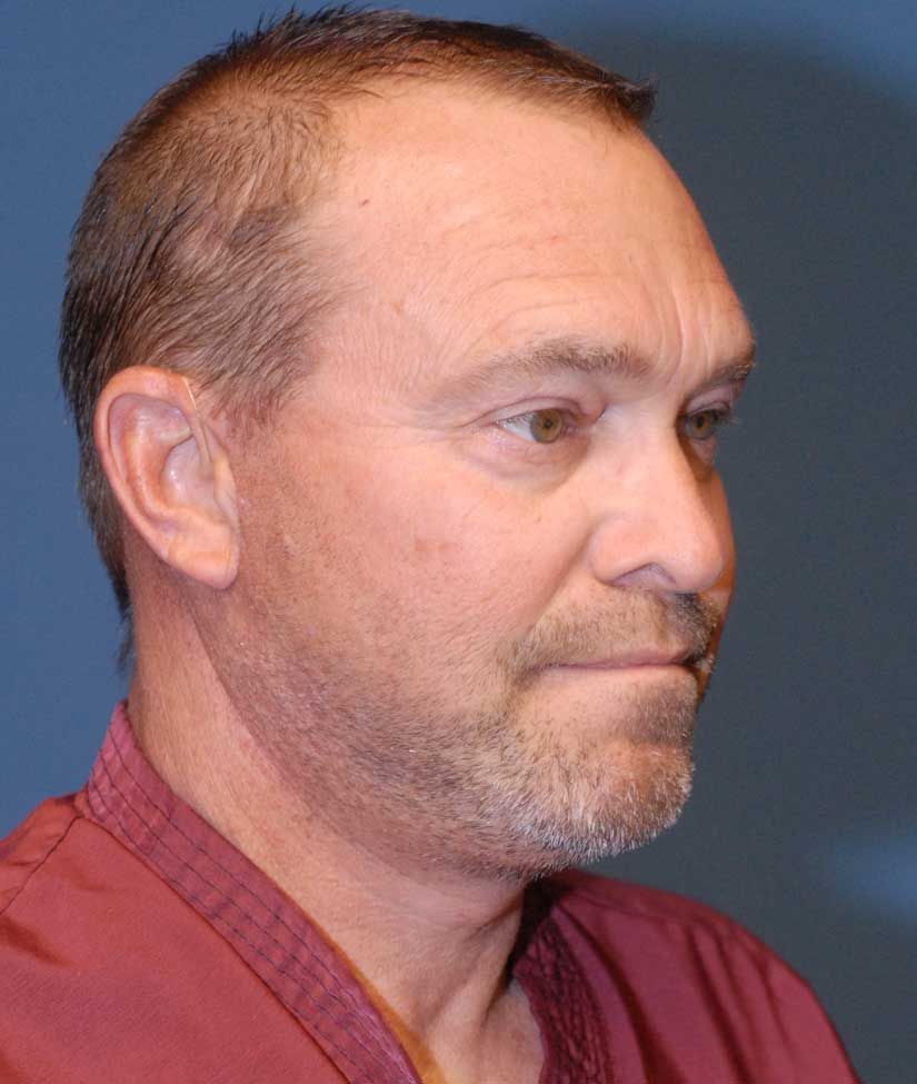 Male Facial Rejuvenation Before & After