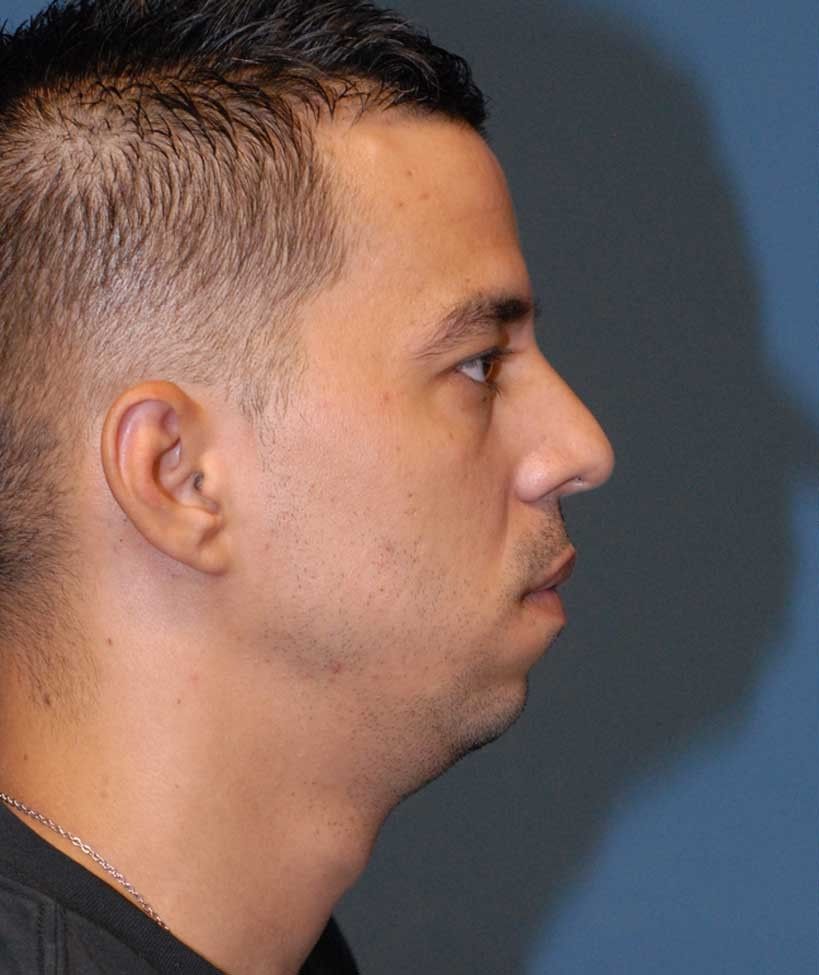 Male Facial Rejuvenation Before & After