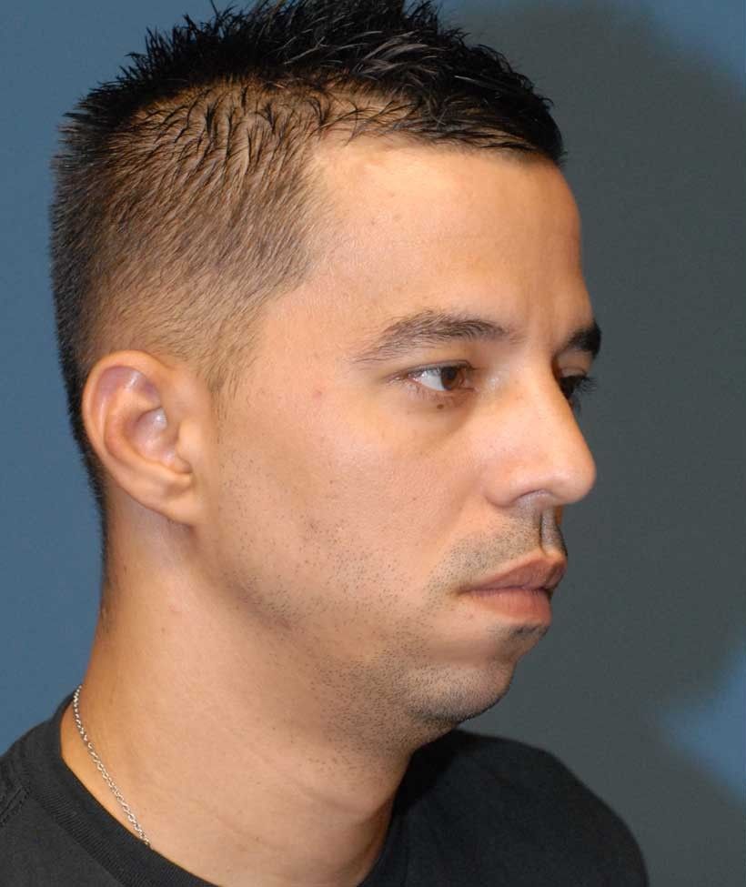 Male Facial Rejuvenation Before & After