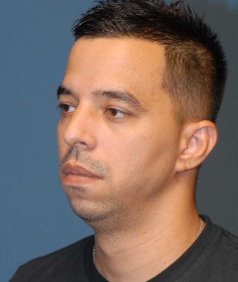 Male Facial Rejuvenation Before & After