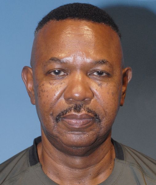 Male Facial Rejuvenation Before & After