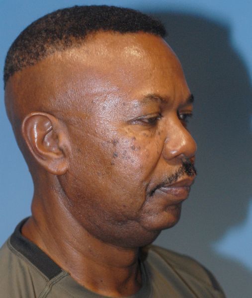 Male Facial Rejuvenation Before & After