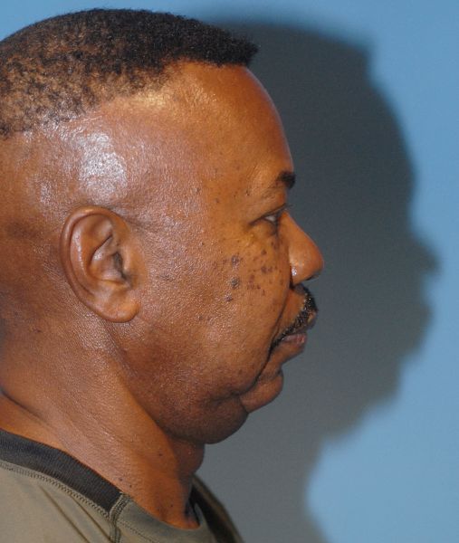 Male Facial Rejuvenation Before & After