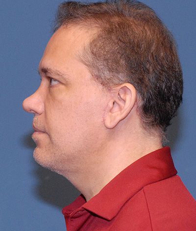 Male Facial Rejuvenation Before & After