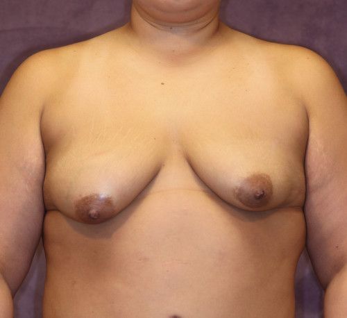 Breast Augmentation And Lift Before & After
