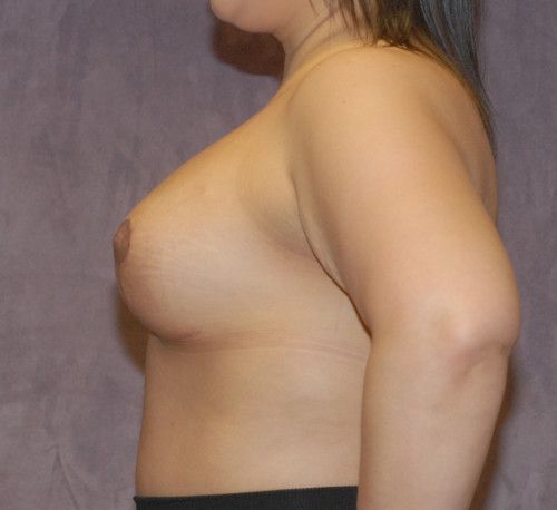Breast Augmentation And Lift Before & After