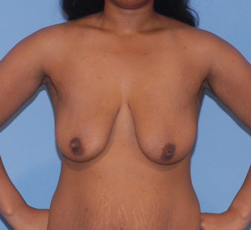 Breast Augmentation And Lift Before & After