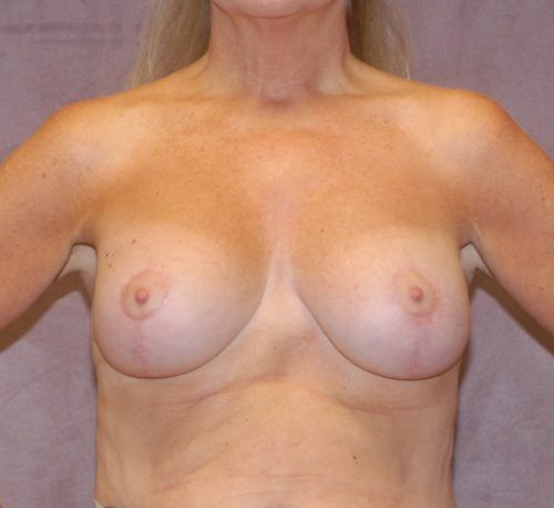 Breast Augmentation And Lift Before & After