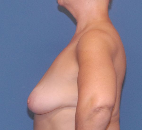 Breast Augmentation And Lift Before & After