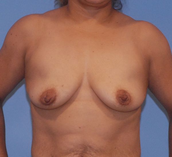 Breast Augmentation And Lift Before & After