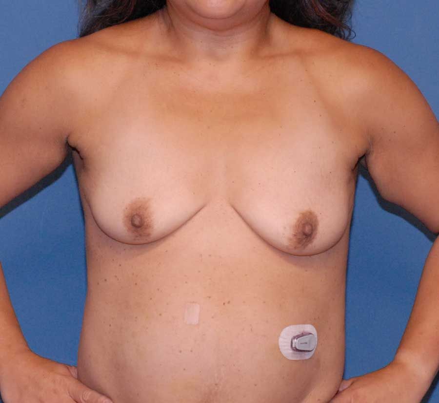 Breast Augmentation And Lift Before & After