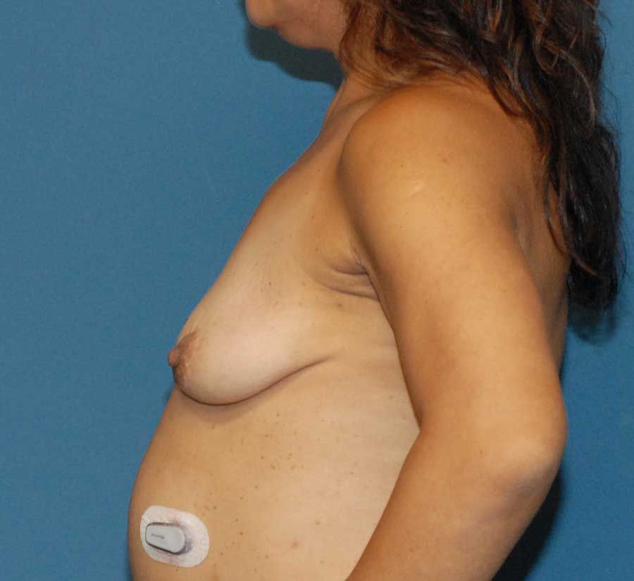 Breast Augmentation And Lift Before & After