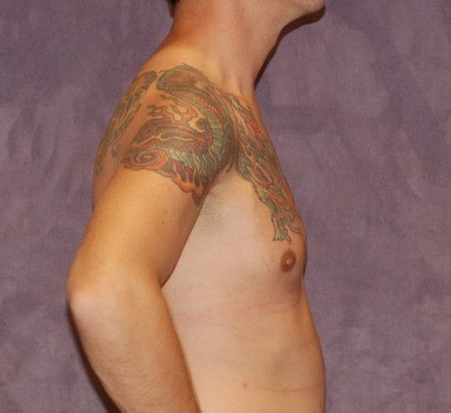 Male To Female Breast Contouring Before & After