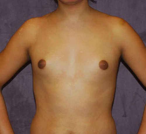 Male To Female Breast Contouring Before & After