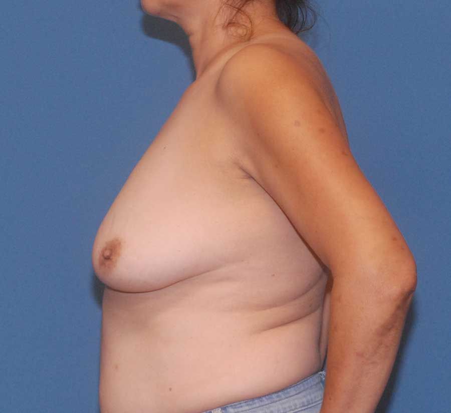 Breast Augmentation Before & After