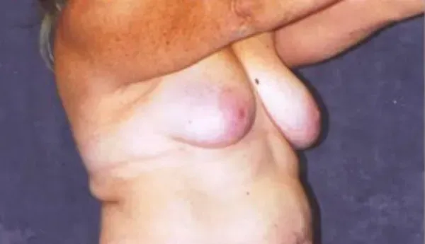 Breast Augmentation Before & After