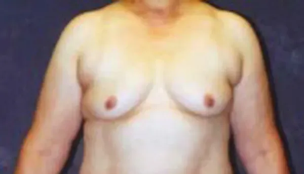 Breast Augmentation Before & After