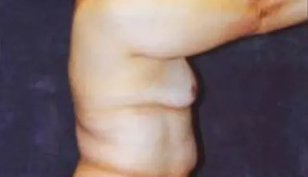 Breast Augmentation Before & After