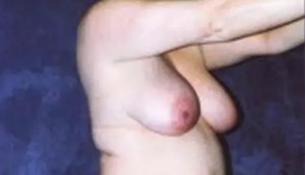 Breast Augmentation Before & After