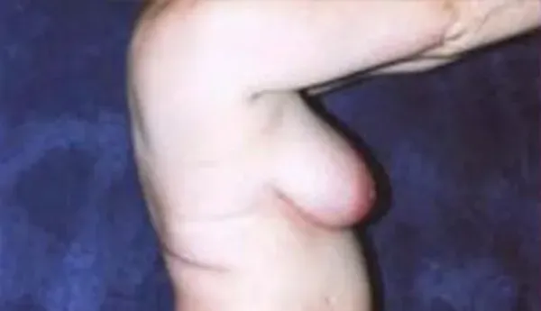 Breast Augmentation Before & After