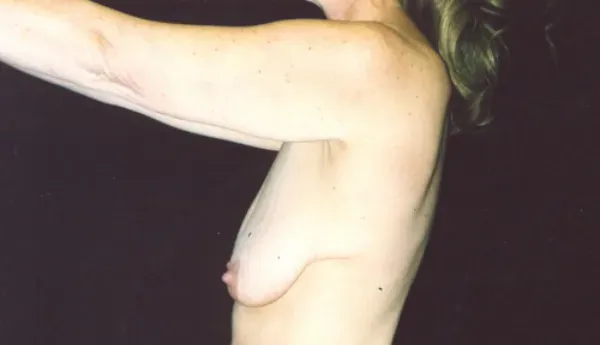 Breast Augmentation Before & After