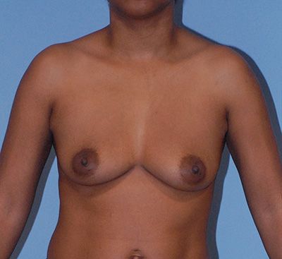 Breast Augmentation Before & After