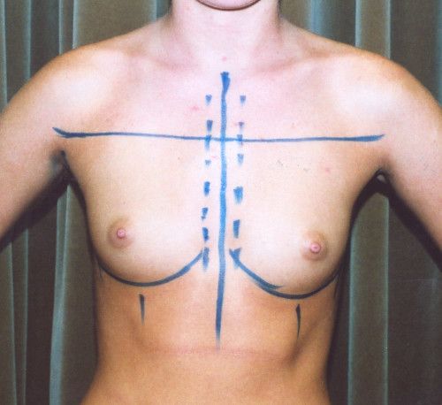 Breast Augmentation Before & After