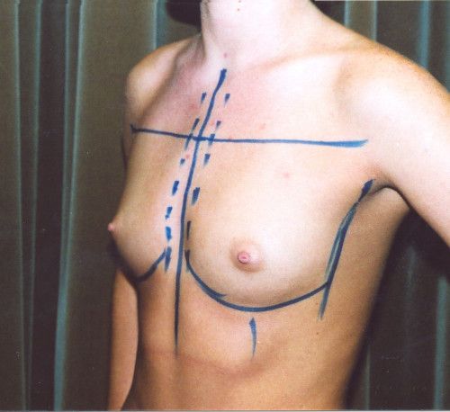 Breast Augmentation Before & After