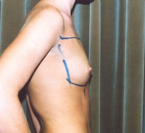 Breast Augmentation Before & After