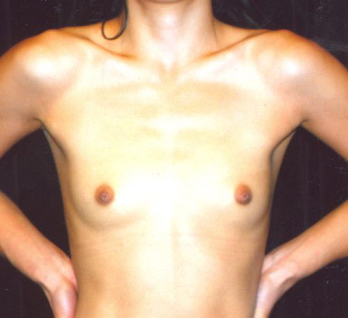 Breast Augmentation Before & After