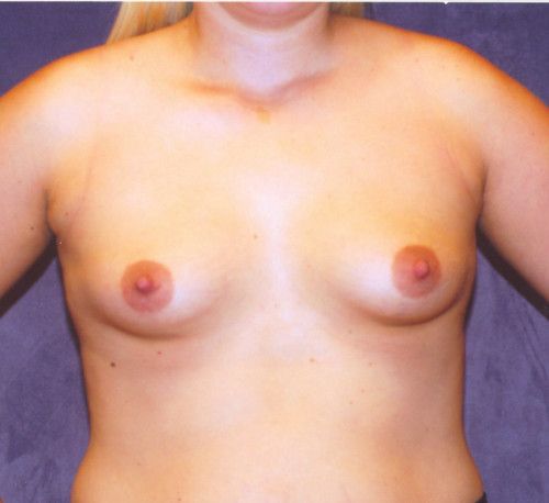 Breast Augmentation Before & After