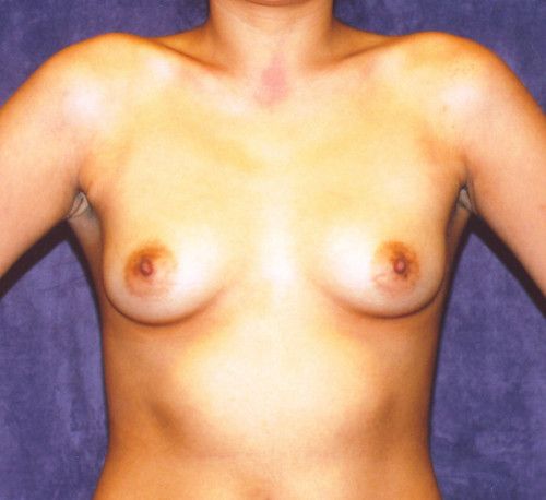 Breast Augmentation Before & After