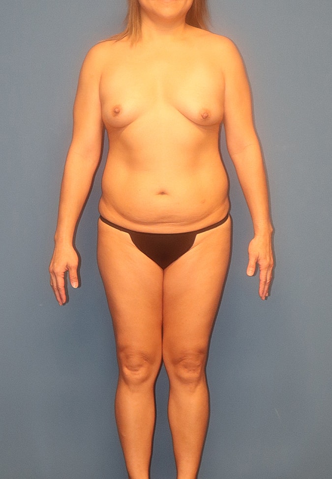 Breast Augmentation Before & After