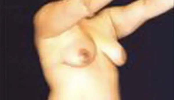 Breast Augmentation Before & After