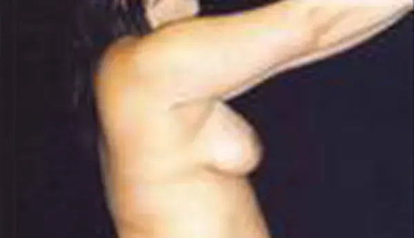 Breast Augmentation Before & After