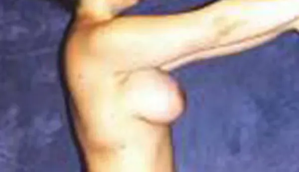 Breast Augmentation Before & After