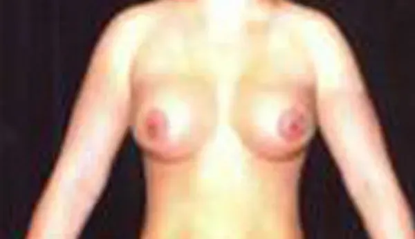 Breast Augmentation Before & After