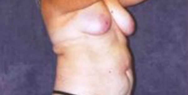 Breast Augmentation Before & After