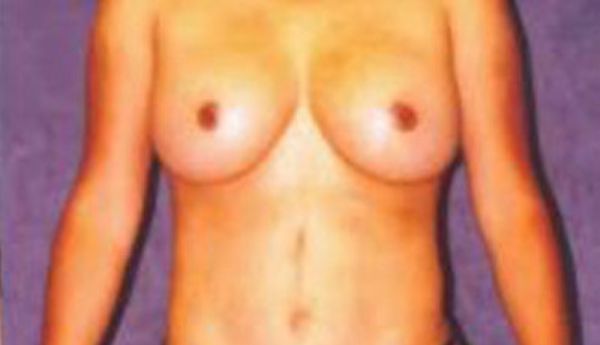 Breast Augmentation Before & After