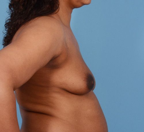 Breast Augmentation Before & After