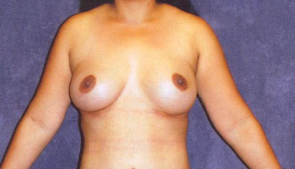 Breast Augmentation Before & After