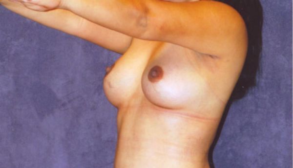 Breast Augmentation Before & After