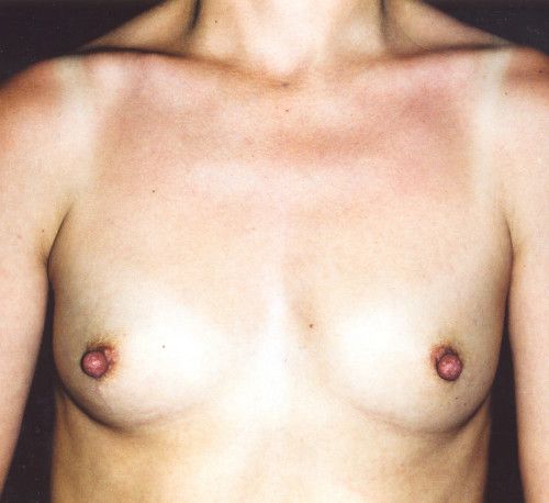 Breast Augmentation Before & After